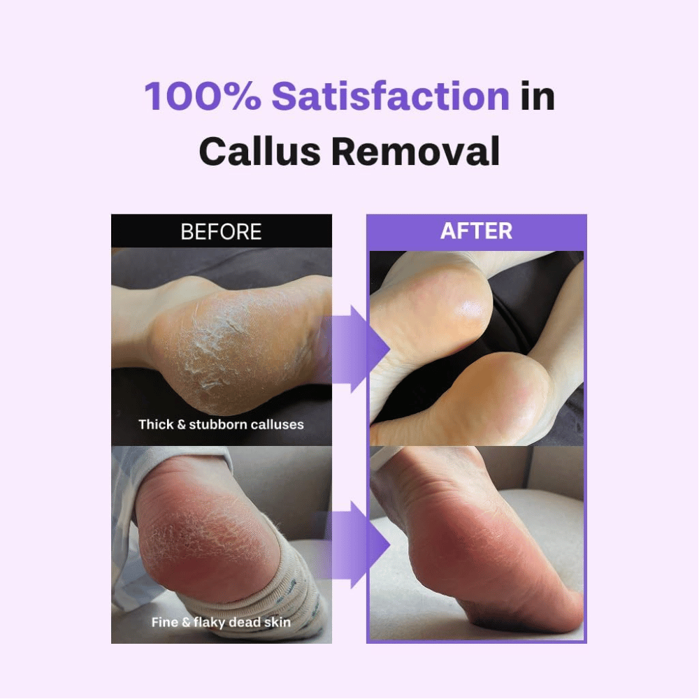 Vor und nach der Anwendung von BAREN Foot Callus Eraser Home Set bei trockenen Füßen, abgestorbener Haut und Hornhaut